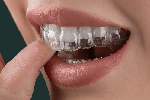 Comprehensive Guide to Finding a Dentist in Leicester and Invisalign Services